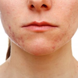 acne scarring on face