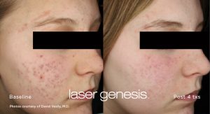 minimize acne scarring with Laser Genesis