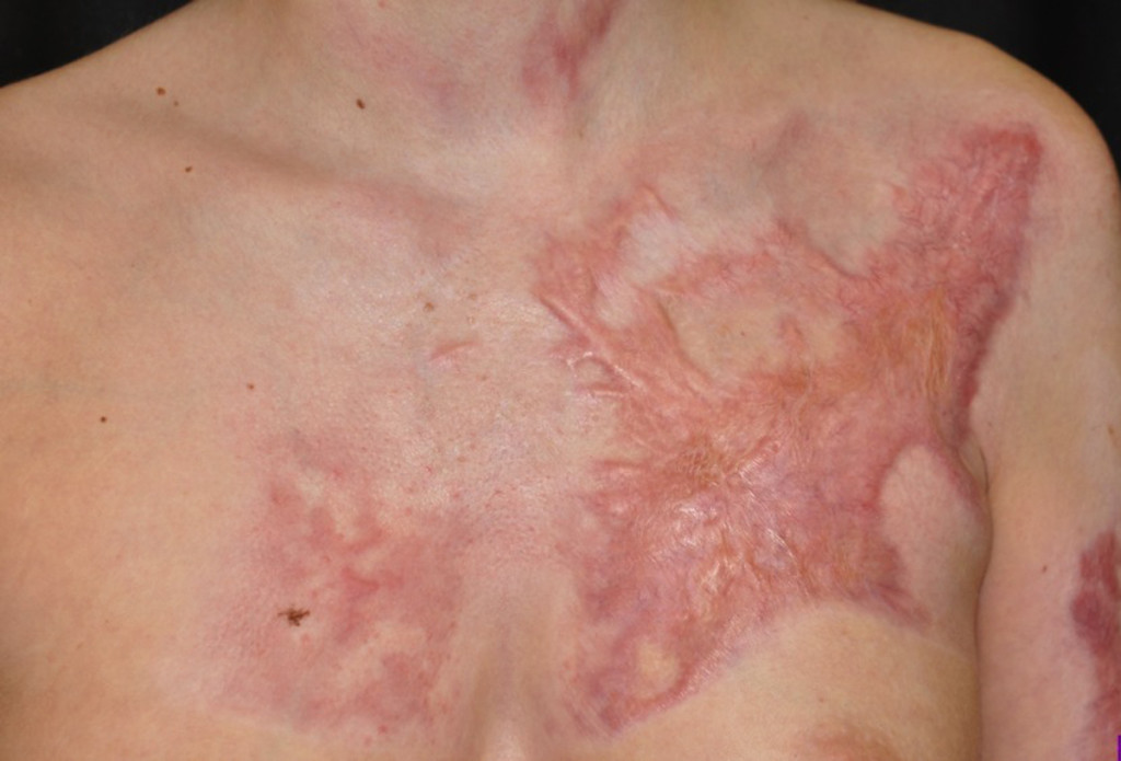 severe burn scar on chest