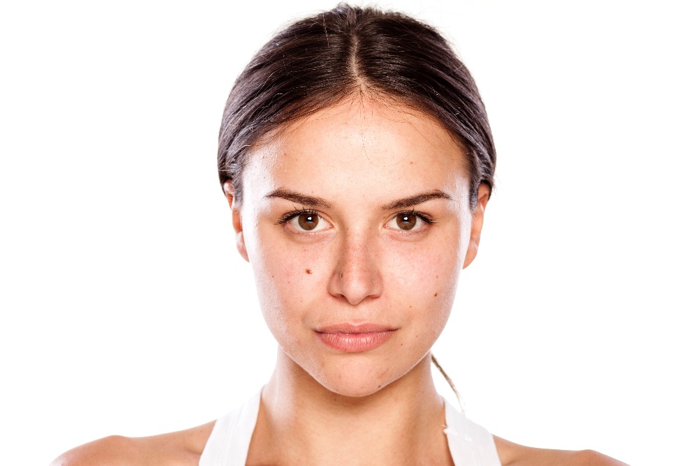 woman with brown spots on face