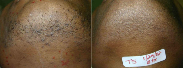laser hair removal dark skin before and after