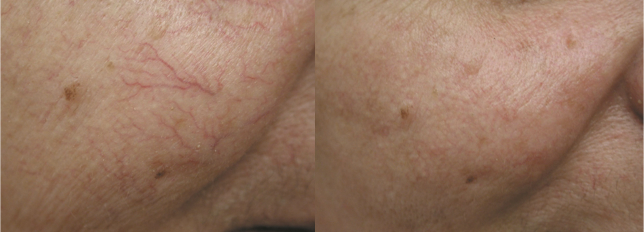 before and after laser treatment