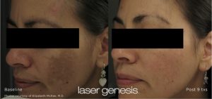 laser genesis before and after