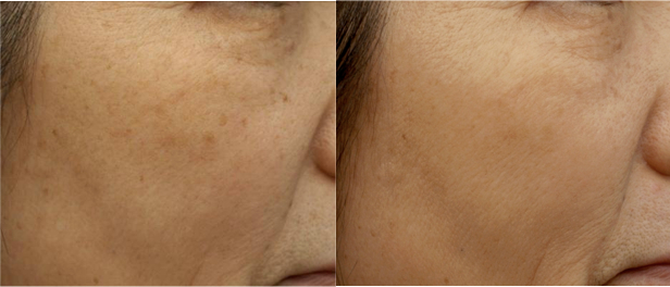 skin blotch treatmemt before and after