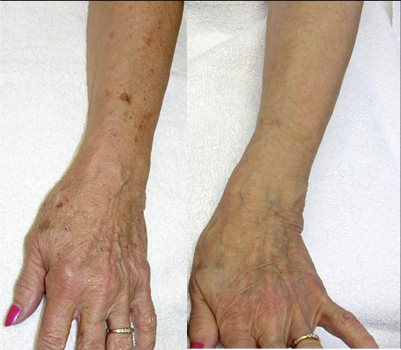 hand with age spots before and after