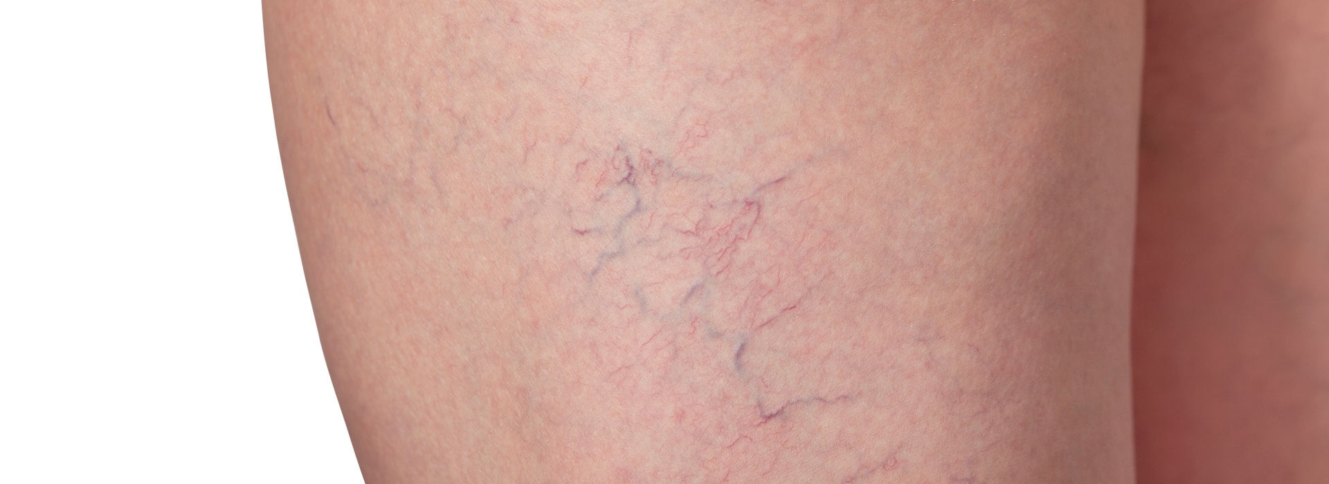 Spider Vein Treatment in Brampton