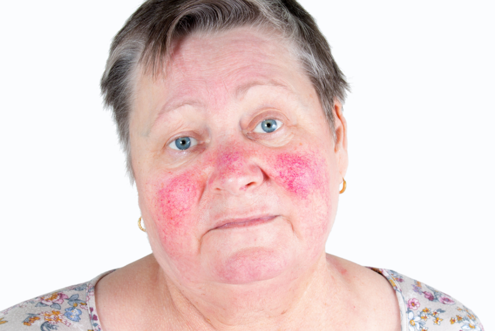 woman with rosacea on face