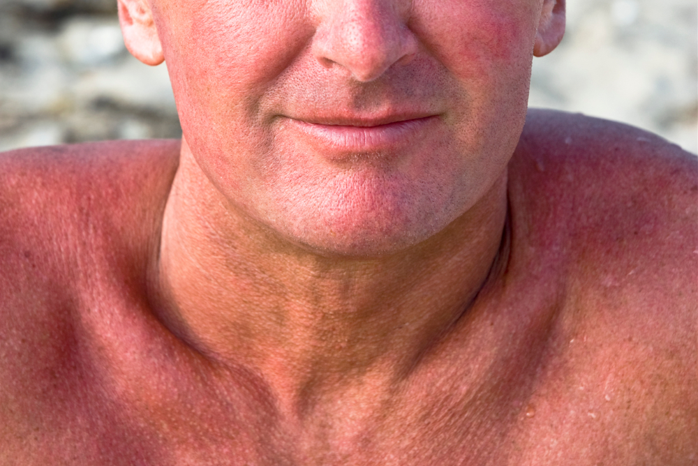 man with sunburn