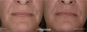 before and after pearl fractional
