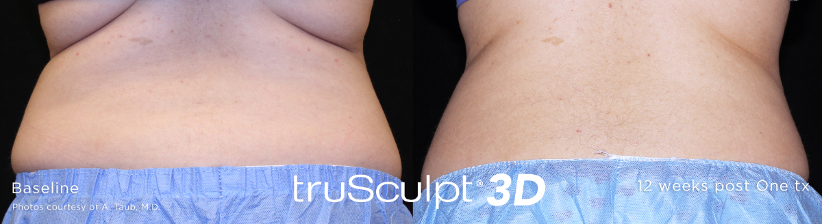 Trusculpt3D before and after back fat