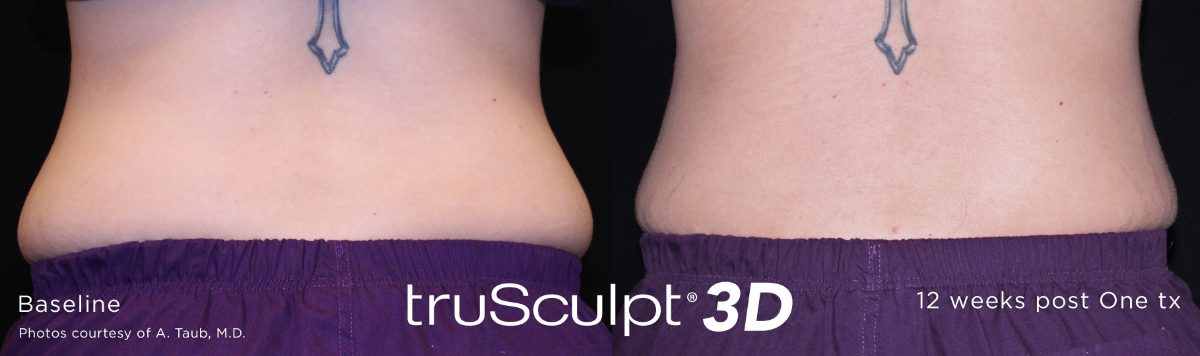 trusculpt 3d before and after muffin top