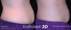Trusculpt 3d to reduce abdomen