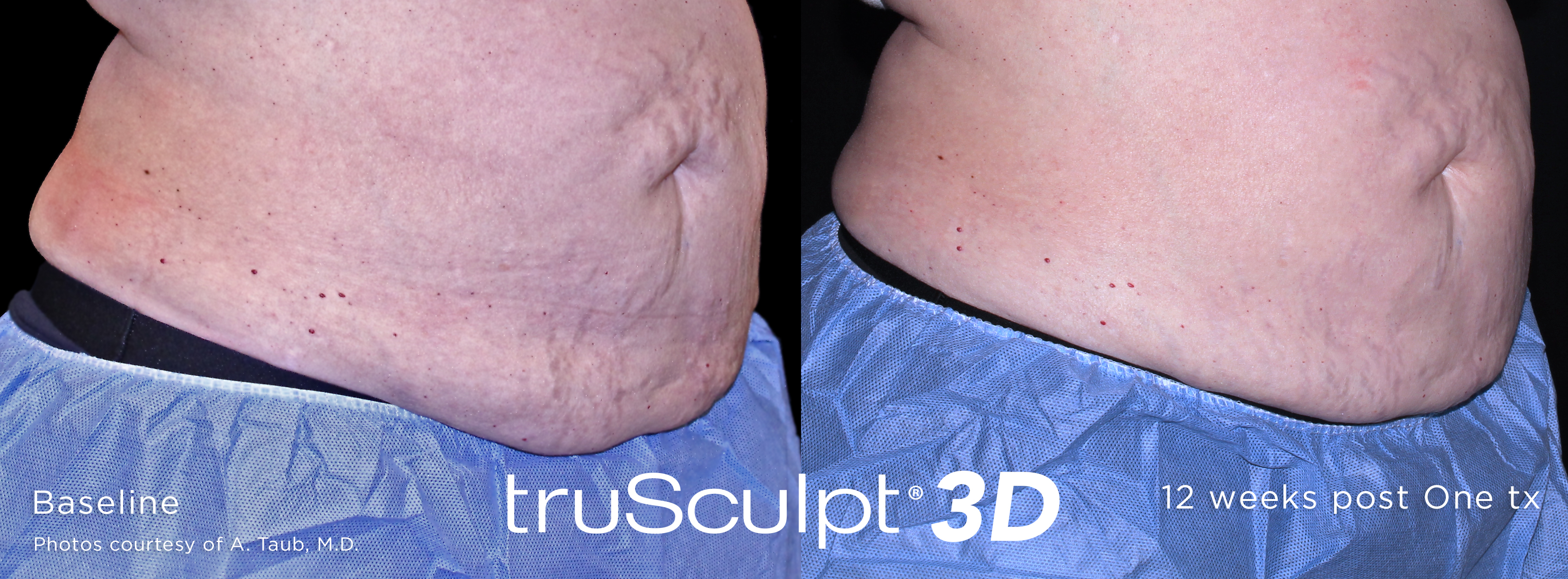 stomach reduction with Trusculpt 3D