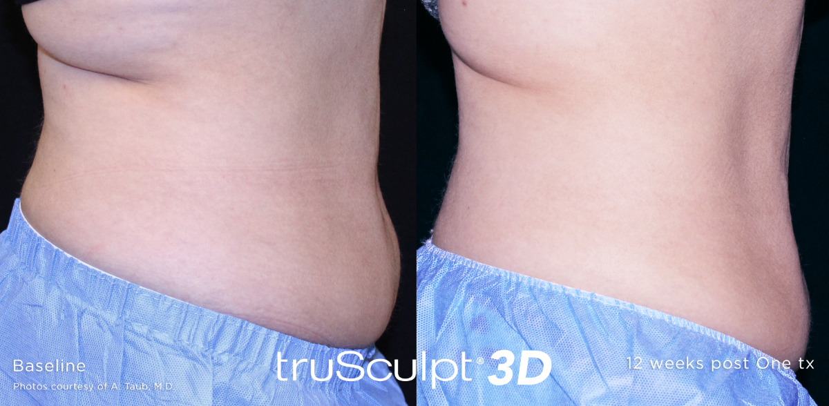 effectiveness of Trusculpt 3D before and after