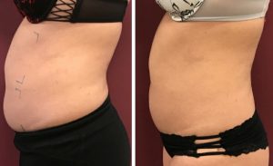 Dramatic before and after Trusculpt 3D results
