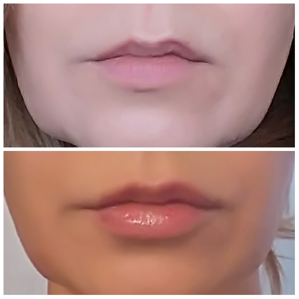 Lip Enhancement Scarborough Laser Surgery